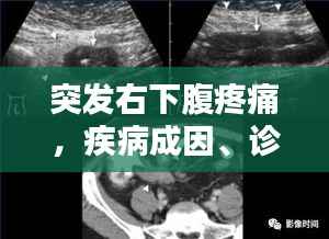 突发右下腹疼痛,疾病成因、诊断方法与治疗方案探讨